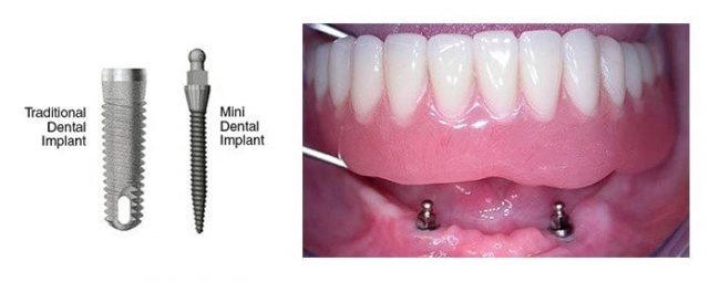 https://prestigedental.al/wp-content/uploads/2021/02/dhembevidamin-640x255.jpg