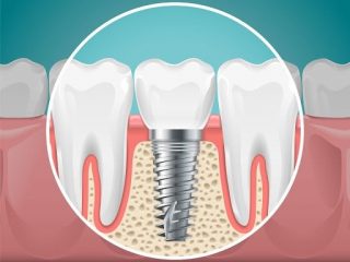 https://prestigedental.al/wp-content/uploads/2021/02/implant22min-320x240.jpg