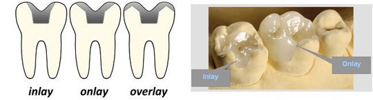 https://prestigedental.al/wp-content/uploads/2021/02/inllll.jpg