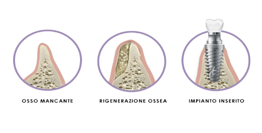 https://prestigedental.al/wp-content/uploads/2021/02/osso22min.png