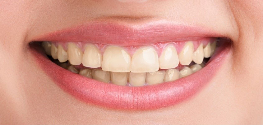 <span class="bt_bb_before_after_image_before_text">Prima</span>
