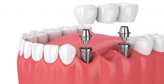 https://prestigedental.al/wp-content/uploads/2021/02/prot22min-320x165.jpg