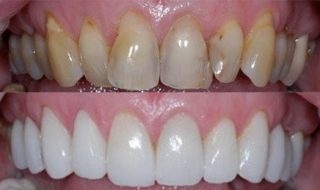 https://prestigedental.al/wp-content/uploads/2021/02/prrrdddd-320x190.jpg