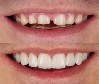 https://prestigedental.al/wp-content/uploads/2021/02/sdfsdfsdgggggmin-320x272.jpg