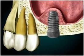 https://prestigedental.al/wp-content/uploads/2021/02/viddhembemin.jpg
